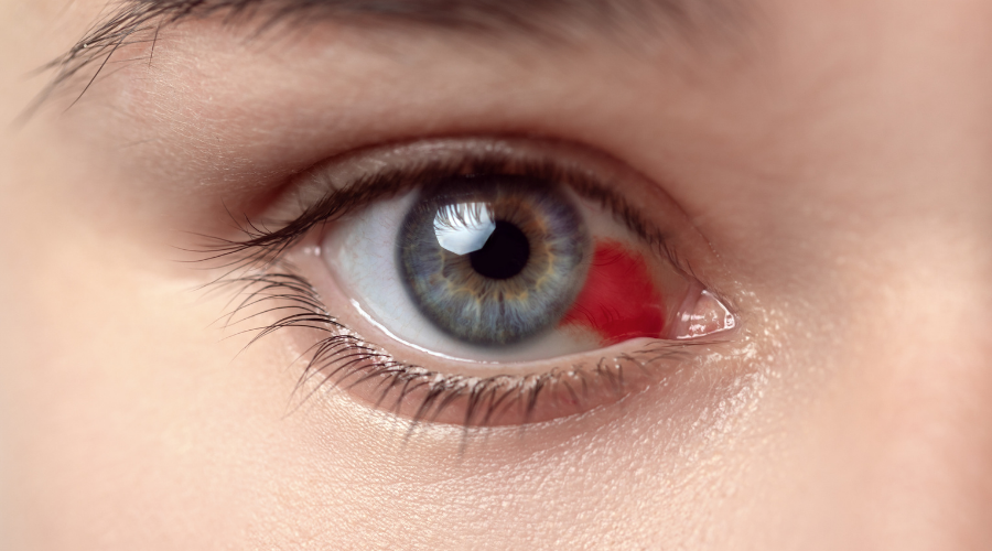 What is Retinal Bleeding Due to Diabetes and Blood Pressure?
