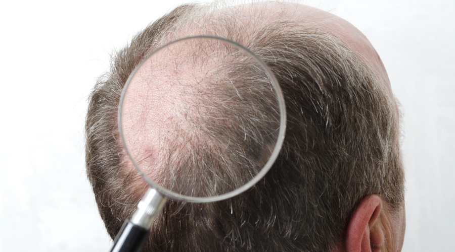 What is Oxygen Hair Transplantation?