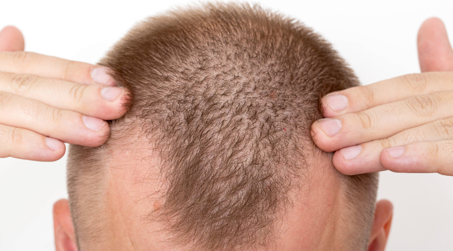 How Is Unshaven Hair Transplantation Done?