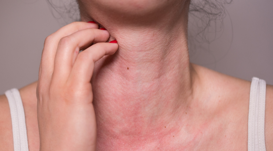 What Are Allergic Skin Diseases?